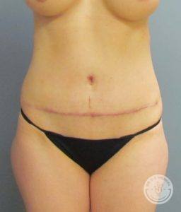 front view of female torso after tummy tuck procedure