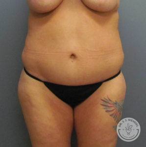 front view of woman's torso before liposuction