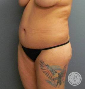 woman's breasts and stomach before liposuction surgery