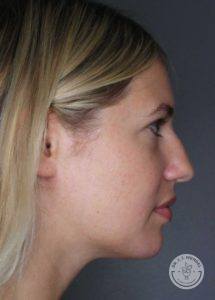 right side profile view of female face before liquid rhinoplasty