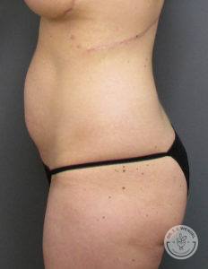 side profile of woman's torso before tummy tuck procedure