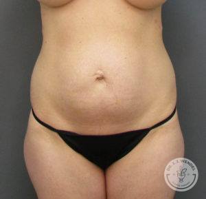 front view of woman's torso before tummy tuck procedure