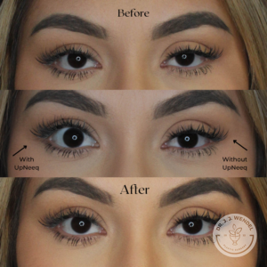 before and after view of woman's eyelids with Upneeq eye drops