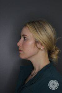 left profile view of woman's face after Kybella injections