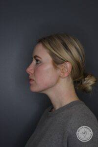 left profile view of woman before Kybella injections