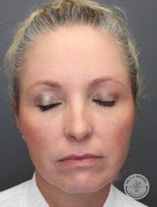 Front view of woman with her eyes closed after receiving upper blepharoplasty surgery