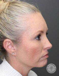 Right profile of woman's face after upper blepharoplasty surgery