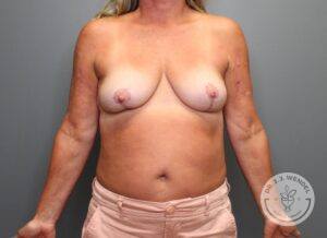 Front view of woman after breast implant removal, capsulectomy, and mastopexy