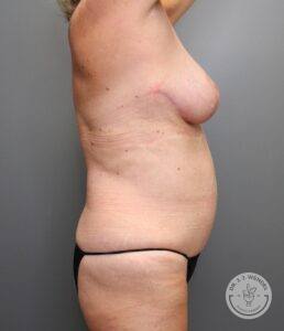 Right profile view of woman's body after mastopexy and upper ab liposuction surgery