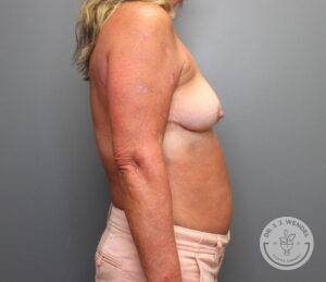 Right profile view of woman after breast implant removal, capsulectomy, and mastopexy