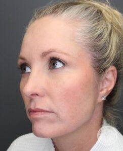 Oblique left view of woman with her eyes closed after upper blepharoplasty surgery