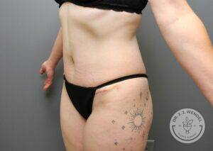 left angled view of woman's torso and lower body after tummy tuck