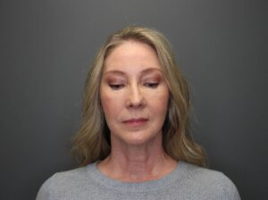 Front view of woman after eyelid surgery looking down