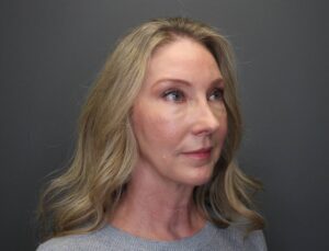 right angled view of woman after eyelid surgery blepharoplasty