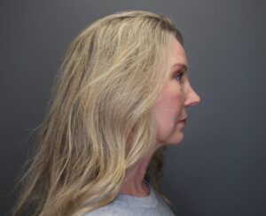 right side view of woman after eyelid surgery blepharoplasty
