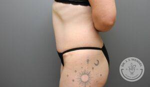 left side view of woman's torso and lower body after tummy tuck