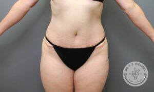 front view of woman's torso and lower body after tummy tuck