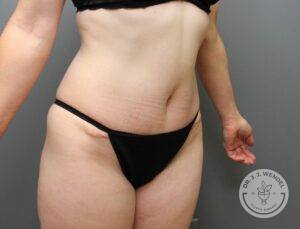 right angled view of woman's torso and lower body after tummy tuck