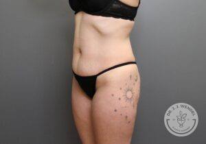 left angled view of woman's torso and lower body before tummy tuck