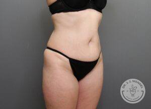 right angled view of woman's torso and lower body before tummy tuck