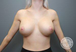 Front view of woman after breast implant exchange surgery