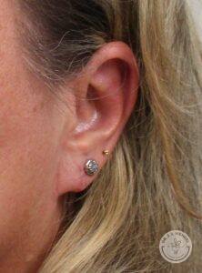 angled view of woman's left ear after earlobe surgery to correct a tear