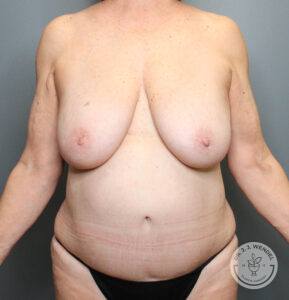 Front view of woman's torso and breasts and breasts before a mastopexy and upper ab lipsouction