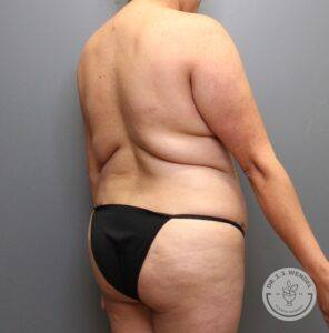 angled right view of woman's back and buttocks before liposuction on trunk and flank