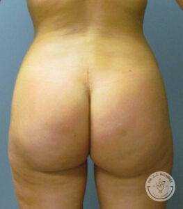 front view of woman's buttocks after augmentation with fat transfer