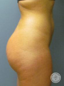 left view of woman's buttocks after augmentation with fat transfer