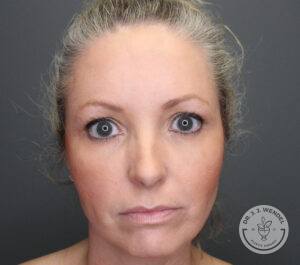 Front view of woman's face before receiving upper blepharoplasty surgery