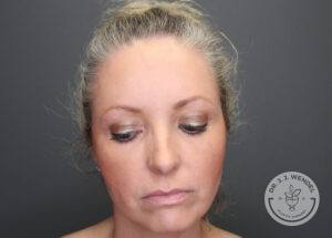 Front view of woman looking down before receiving upper eyelid surgery