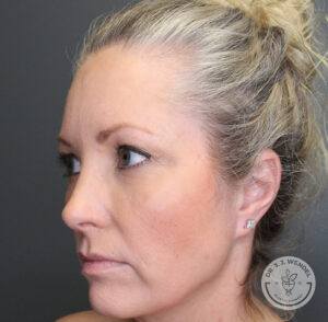 Left profile view of woman's face before receiving upper eyelid surgery