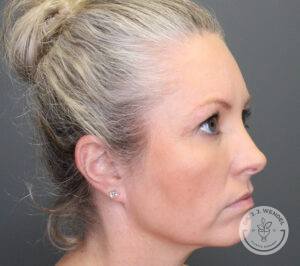 Right profile view of woman looking up before receiving upper eyelid surgery