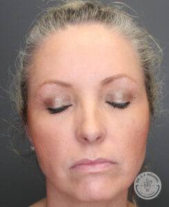 Front view of woman with her eyes closed before receiving upper eyelid surgery