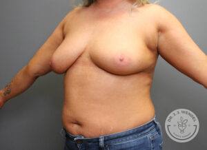 angled left view of woman's torso before breast augmentation