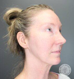 Slightly right profile of woman before eyelid surgery