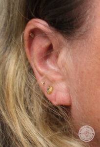 angled view of woman's right ear before earlobe surgery to correct a tear