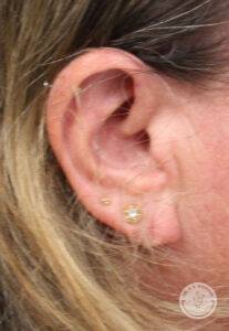 front view of woman's right ear before earlobe surgery to correct a tear