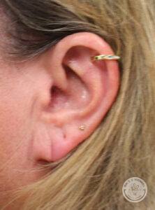 front view of woman's left ear before earlobe surgery to correct a tear