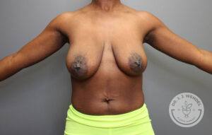 front view of woman's torso before breast lift