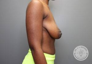Right profile view of woman's breasts and torso before her breast lift surgery (mastopexy)