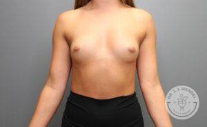Front view of woman's torso before breast augmentation with implants