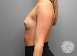 Left profile view of woman's torso after breast augmentation with implants