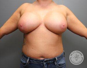 front view of woman's torso after breast augmentation with implants