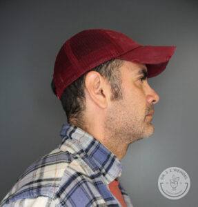 right profile view of man in red hat after chin augmentation