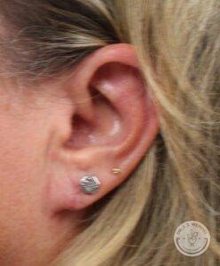 front view of woman's left ear after earlobe surgery to correct a tear