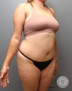 angled right view of woman's torso after liposuction and abdominoplasty scar revision surgery