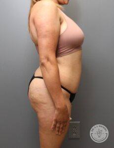 profile view of woman's torso after liposuction and abdominoplasty scar revision surgery