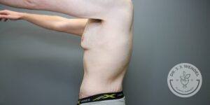 Side profile of torso without excess skin after tummy tuck